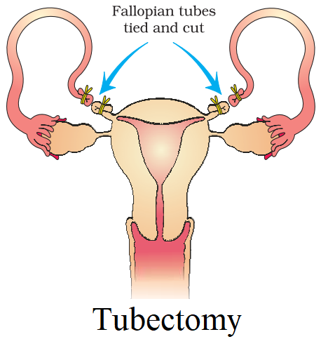 NCERT Solution Class 12 Biology Chapter 4 Reproductive Health – Class 12 Biology Chapter 4